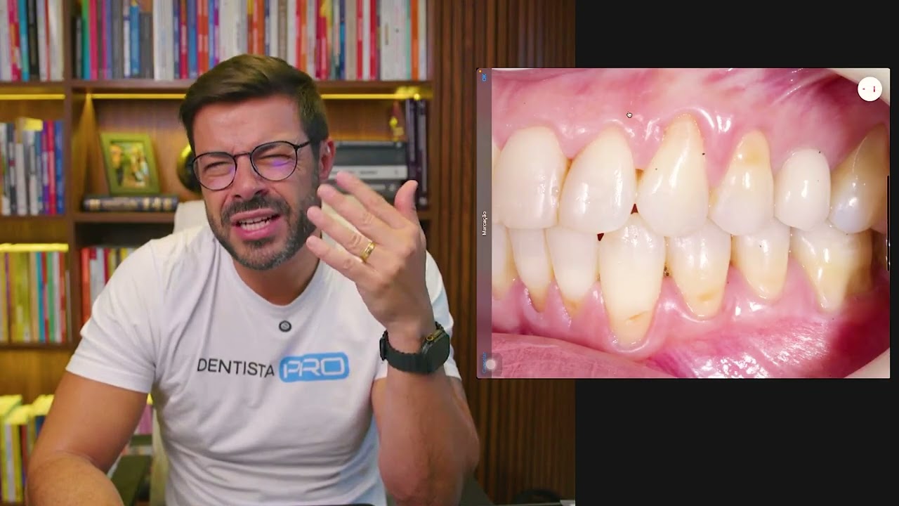 Recessão Gengival: muito além da Estética