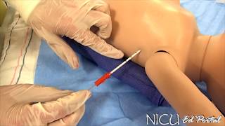 NICU Procedures: Turkel Chest Tube Placement