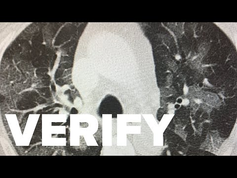 Are post COVID-19 lungs worse than long-time smokers' lungs? | VERIFY