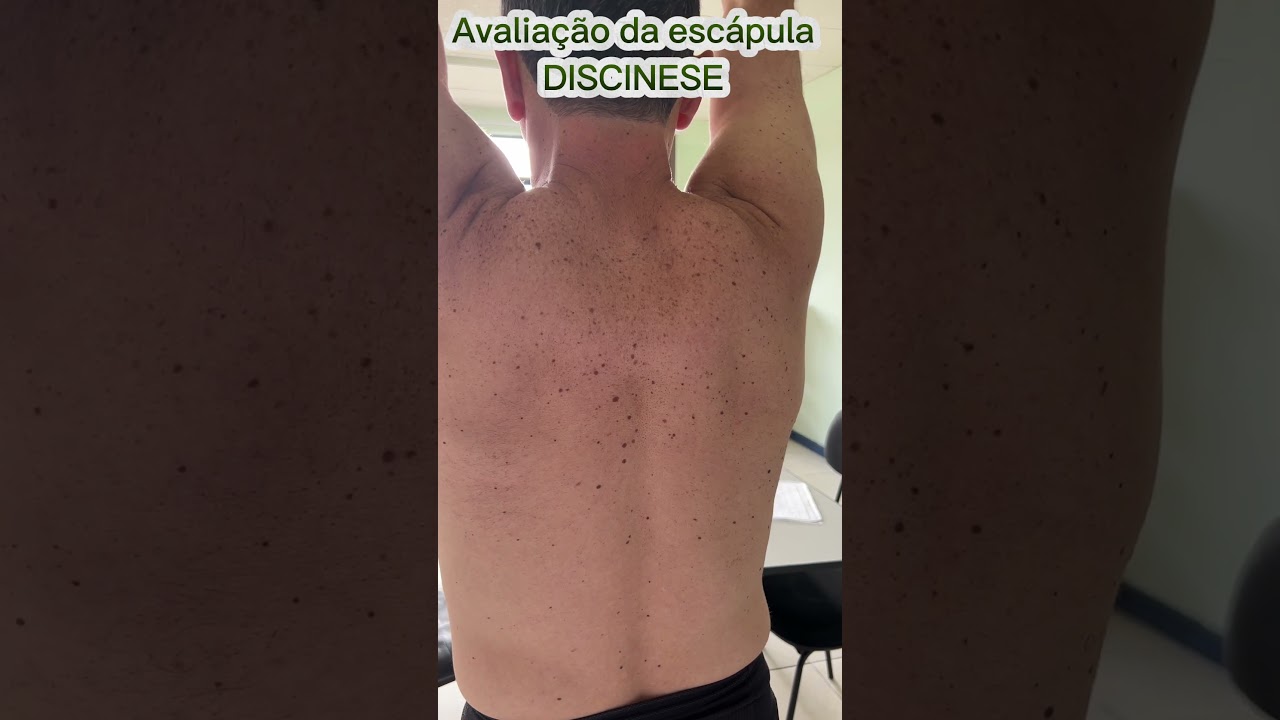 ☑️ Discinese escapular - Tratamento do ombro