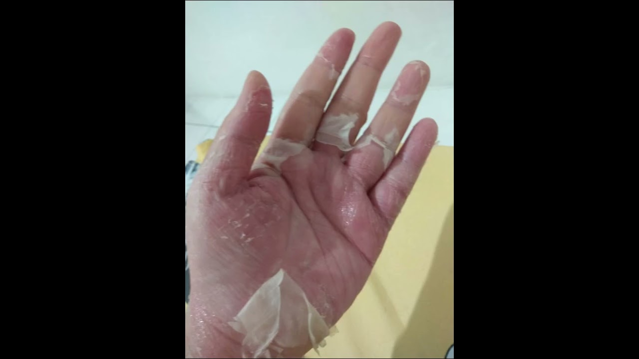 Kesaksian Kesembuhan dari Steven Johnson Syndrome