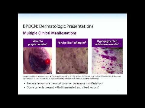 Blastic plasmactoid dendritic cell neoplasm (BPDNC):An Overview –Dr. Ghaleb Elyamany(Sep15-16, 2023)