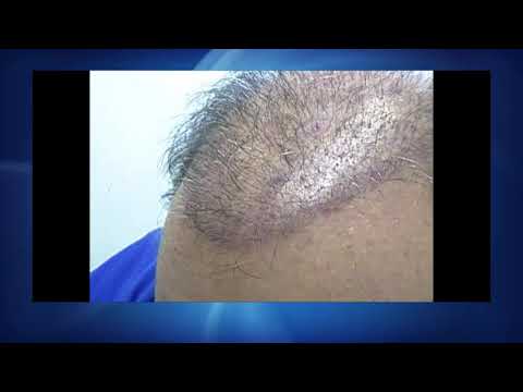 How to clean your hair transplant for Dr. Lindsey patients | McLean | VA | DC thumbnail