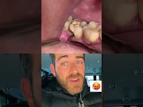 Il consulte parce qu’il a une mauvaise haleine et voilà ce qu’il trouve’🥵 #shorts