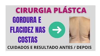Cirurgia para retirar a gordura e flacidez das costas: resultado e cuidados após.