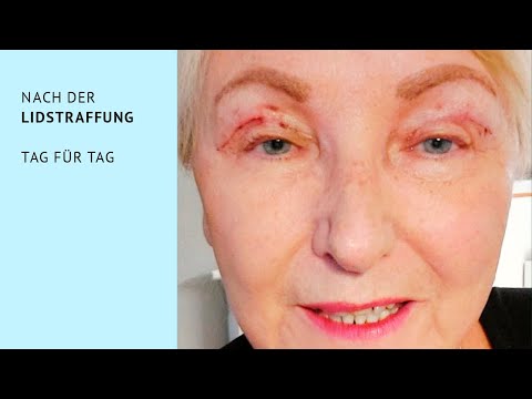 Patientenstory Teil 3: Nach der Lidstraffung
