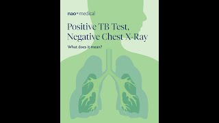 Positive TB Test, Negative Chest X-Ray: What Does It Mean