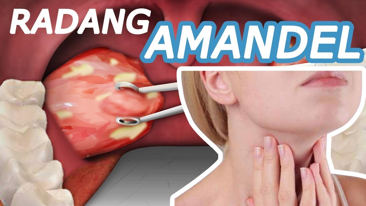 Apa Penyebab Penyakit Amandel? Fakta Menakjubkan yang Perlu Anda Ketahui! Apa Penyebab Penyakit Amandel? Fakta Menakjubkan yang Perlu Anda Ketahui!