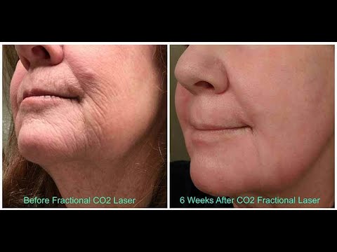 The appearance of the 10600nm CO2 Fractional laser machine