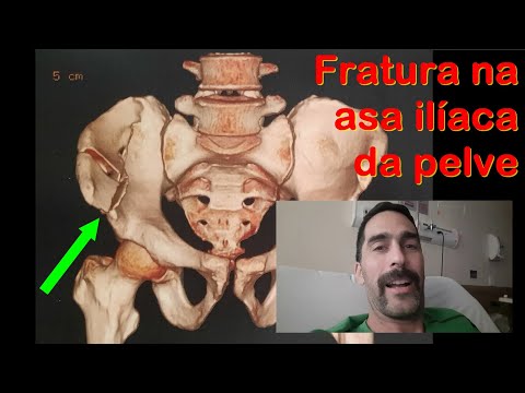 Não tem mais desafio aqui, fratura na bacia (pelve, pélvis)