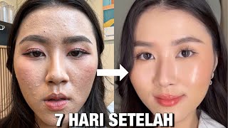 Download lagu Cara aku Ngatasin BRUNTUSAN dan TEKSTUR KULITKU dalam 7 hari (tanpa perawatan, cuma dirumah)✨ mp3