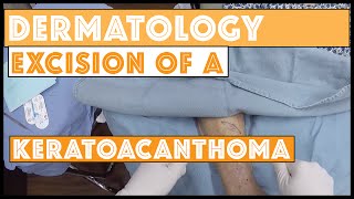 Excision of a skin cancer, a keratoacanthoma, filmed with my GoPro