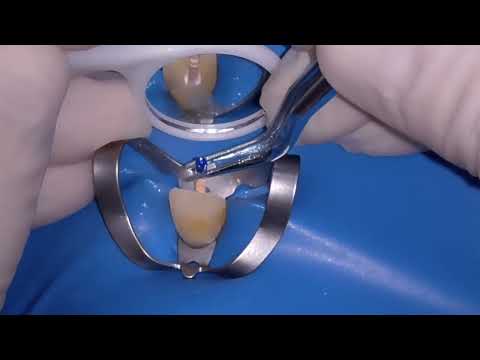 Obturation au biocéramique – Endodontie