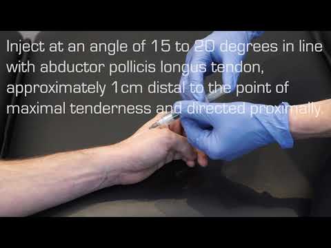 Injection Technique for De Quervain’s Tenosynovitis