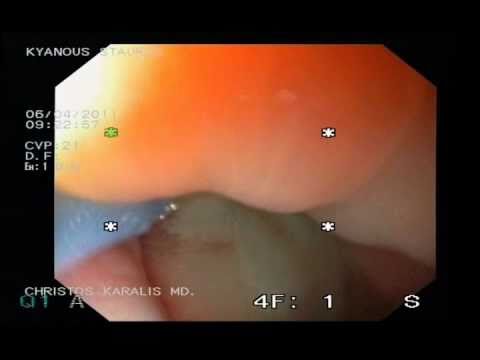 Endoskopowa Resekcja Dysplastycznego Guzka W Przebiegu Przełyku Barrett'a