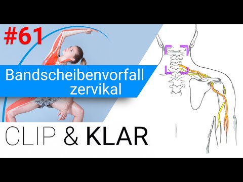 zervikaler Bandscheibenvorfall erklärt - Schmerzausstrahlung in den Arm