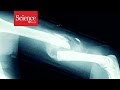 Tiny Bubbles Help Heal Broken Bones