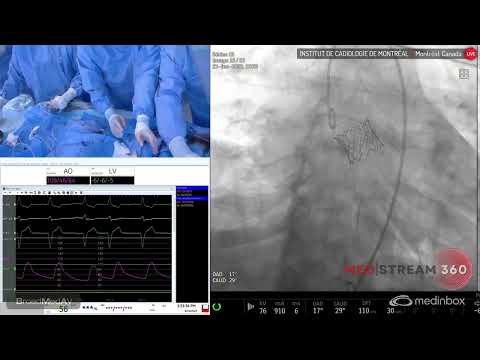 TAVI Using A 23 mm Edwards S3 Valve