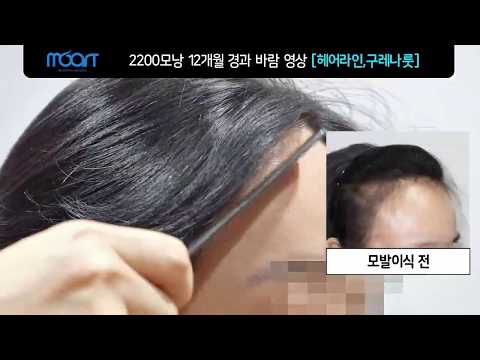 12개월 경과 2200모낭 헤어라인,구레나룻 바람 영상