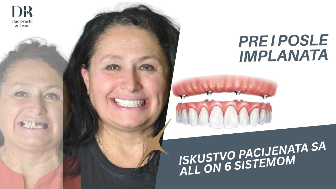 Video svedočenje pacijentkinje — All-on-6, ordinacija dr Radlovački