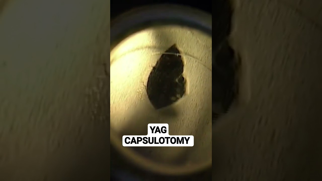 YAG CAPSULOTOMY