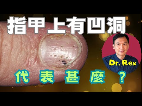 指甲凹