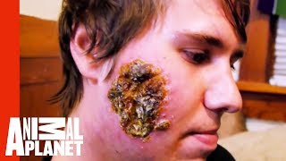 Huge Open Wound on a Young Man&#39;s Face | Monsters Inside Me