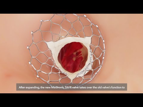 TAVR Patient Procedural Animation