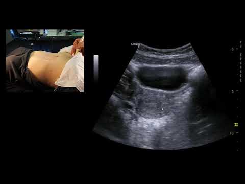 Ultrasound of the pelvic organs