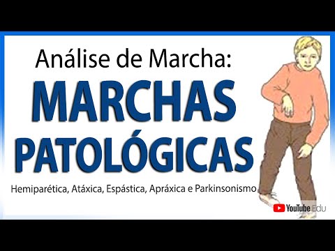 ANÁLISE DE MARCHA: MARCHAS PATOLÓGICAS (Vídeo Aula) - Rogério Souza
