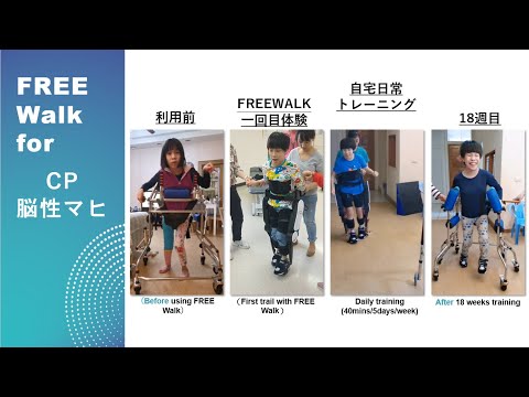 電気刺激により対麻痺者が再び歩けるようになる