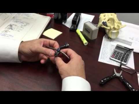 Removal of Depuy Monarch Offset system