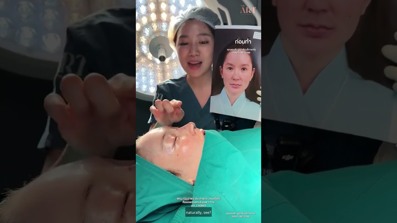 Open Nose Surgery, done right. 👃✨