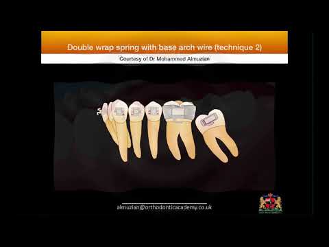Uprighting impacted molars