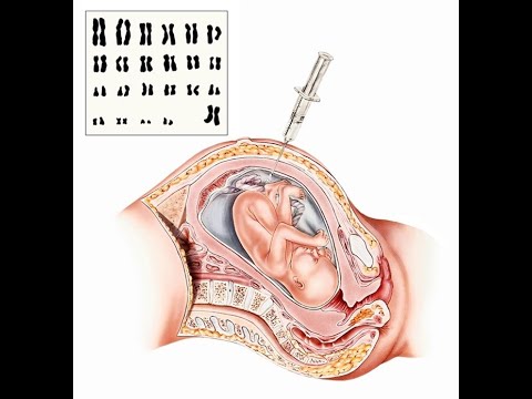 , title : 'شرح مفصل لتحليل السائل الأمنيوسي،Amniocentèse صحة الجنين تحت المجهر !!!!'