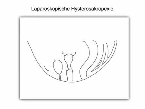 Video Laparoskopische Hysterosakropexie