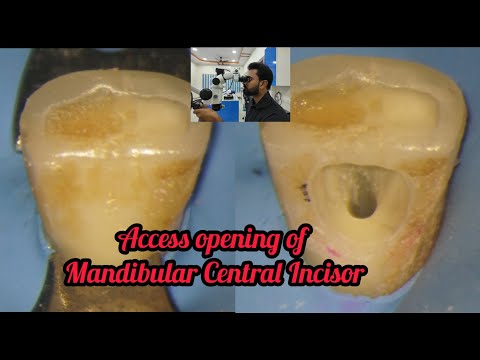 Access opening of Mandibular Central Incisor step by step demonstration# rct for beginners #rct