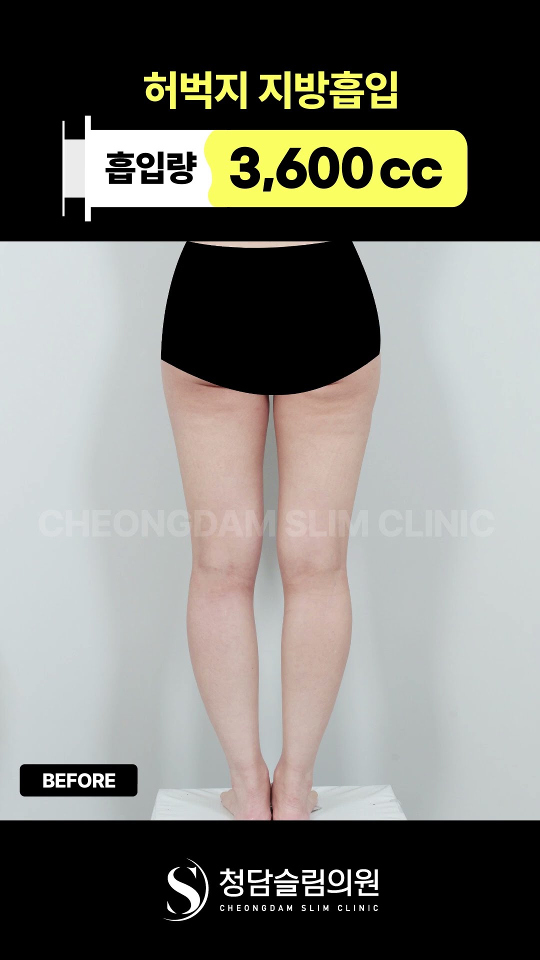 허벅지 지방흡입 전후… 이 정도 차이 남?