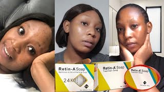 TIPS ON HOW TO BEST USE RETIN A SOAP + REVIEW | DIFFERENCE BETWEEN RETIN A SOAP AND RETIN A SOAP 24k