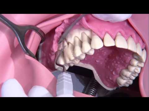 Parodontale Chirurgie (modifizierte Widmanoperation)