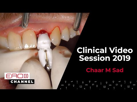 Customized root-analog immediate single implant