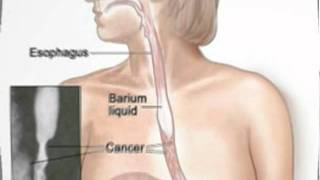 Understanding Esohageal Cancer,  Part II: Diagnosis
