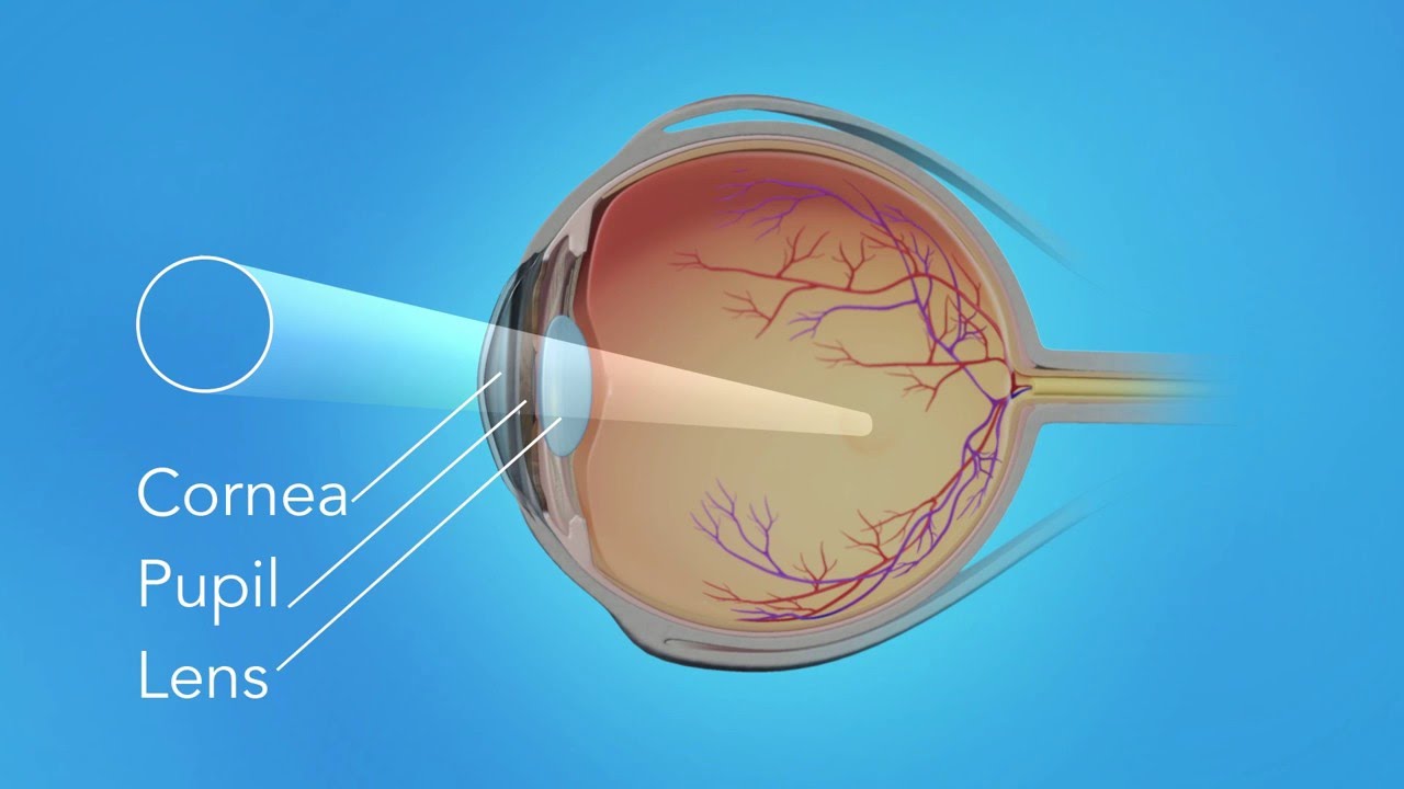 Detached Retina: Pneumatic Retinopexy