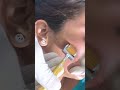 Why You Really Need DERMA ROLLER TREATMENT FOR ACNE SCARS Viral Shorts