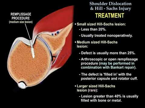 Shoulder Dislocation & Hill Sachs Injury - Everything You Need To Know - Dr. Nabil Ebraheim