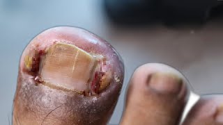 removing the worst ingrown toenail ever 