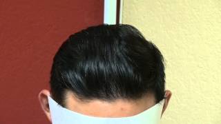 preview picture of video 'Excellent  Los Gatos Near San Jose Male  Hair Transplant Surgery Result Dr. Diep www.mhtaclinic.com'