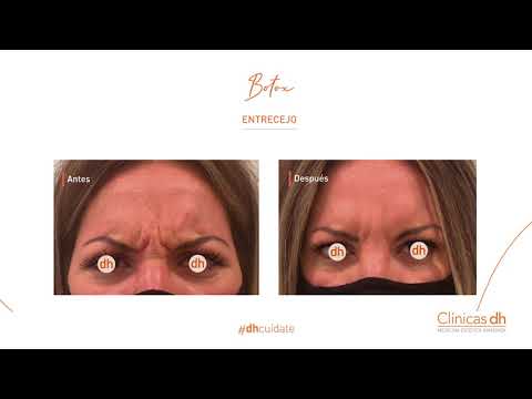 Clínicas DH - Toxina Botulínica - Botox | Medicina Estética Facial