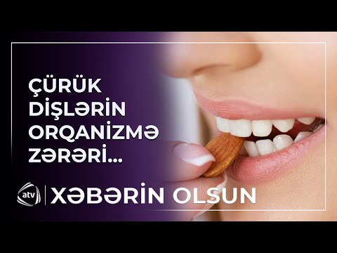 Qeyri-sağlam dişlər hansı fəsadlar yarada bilər?