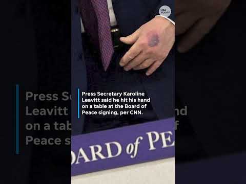 Photos show new bruise on Trump's hand at World Economic Forum